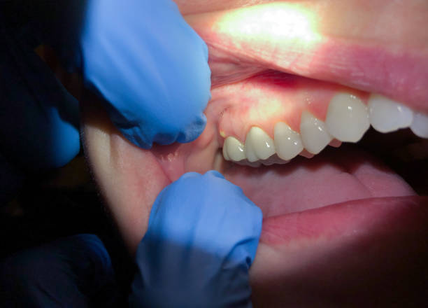 Best Emergency Broken Tooth Repair in Brightwood, VA